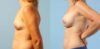Breast Augmentation case #6303 slider thumbnail