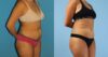Liposuction case #5967 slider thumbnail