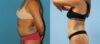 Liposuction case #5967 slider thumbnail