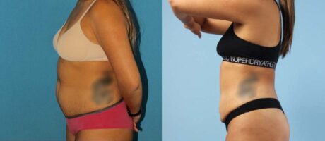 Liposuction case #5967