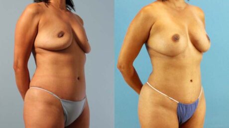 Fat Grafting to the Breast case #256180