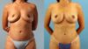 Fat Grafting to the Breast case #256180 slider thumbnail