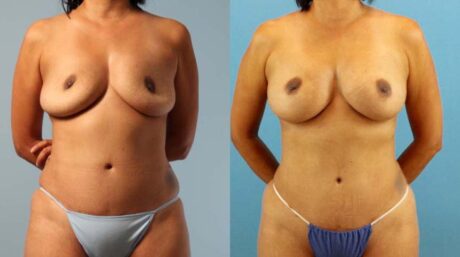 Fat Grafting to the Breast case #256180