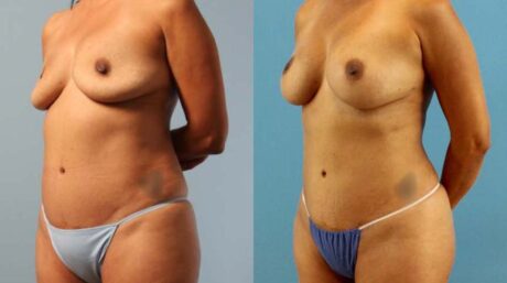 Fat Grafting to the Breast case #256180