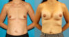 Breast Augmentation case #6309 slider thumbnail