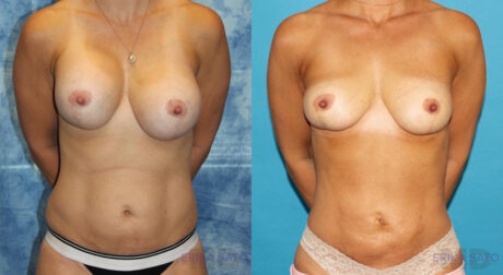 Fat Grafting to the Breast case #258482