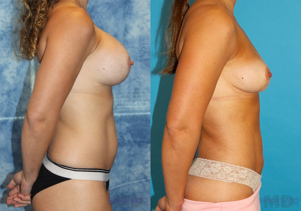 Fat Grafting to the Breast case #258482