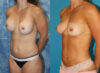 Fat Grafting to the Breast case #258482 slider thumbnail