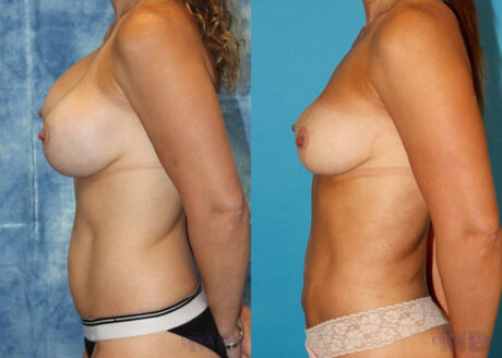 Fat Grafting to the Breast case #258482