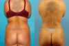 Tummy Tuck case #7344 slider thumbnail