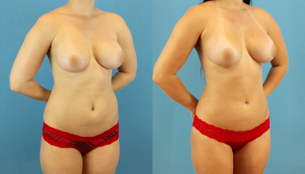 Brazilian Butt Lift case #4905