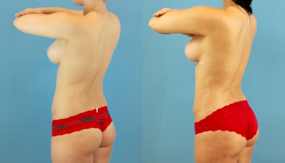 Brazilian Butt Lift case #4905