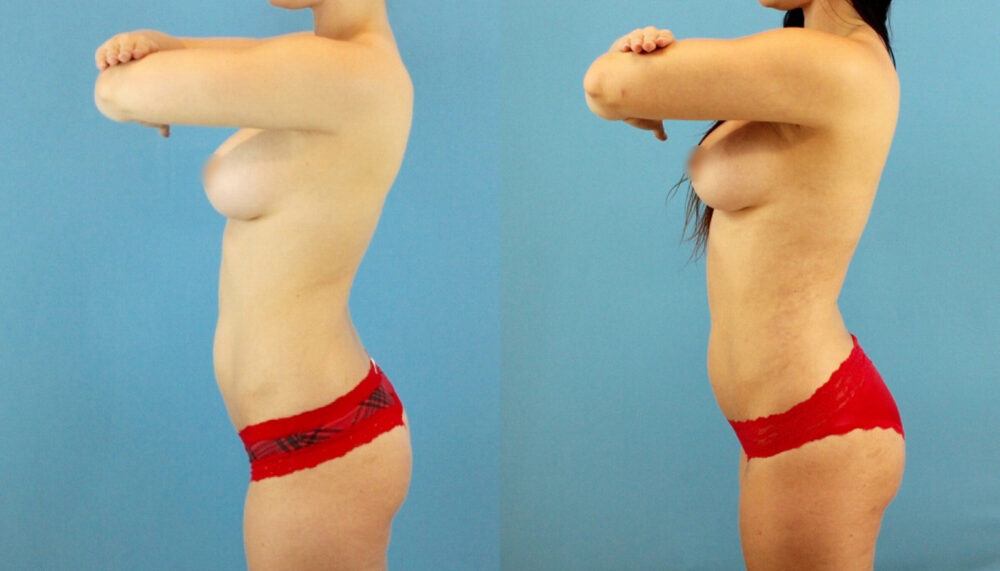 Brazilian Butt Lift case #4905