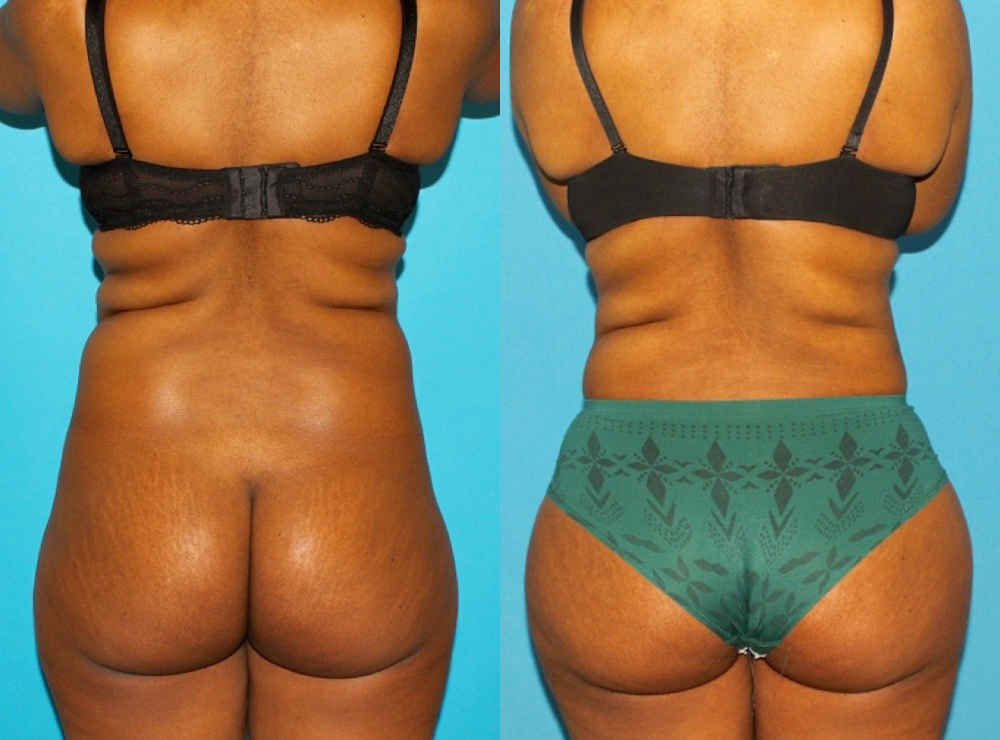 Brazilian Butt Lift case #4906