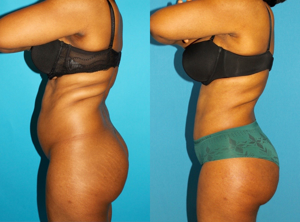 Brazilian Butt Lift case #4906