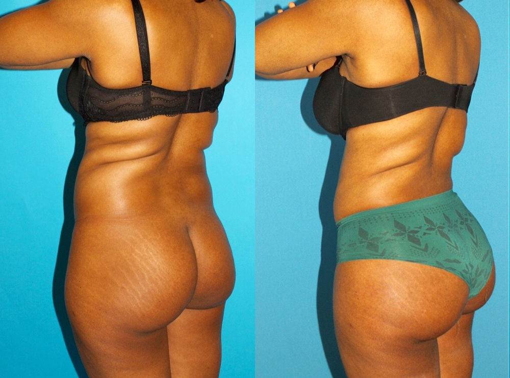 Brazilian Butt Lift case #4906