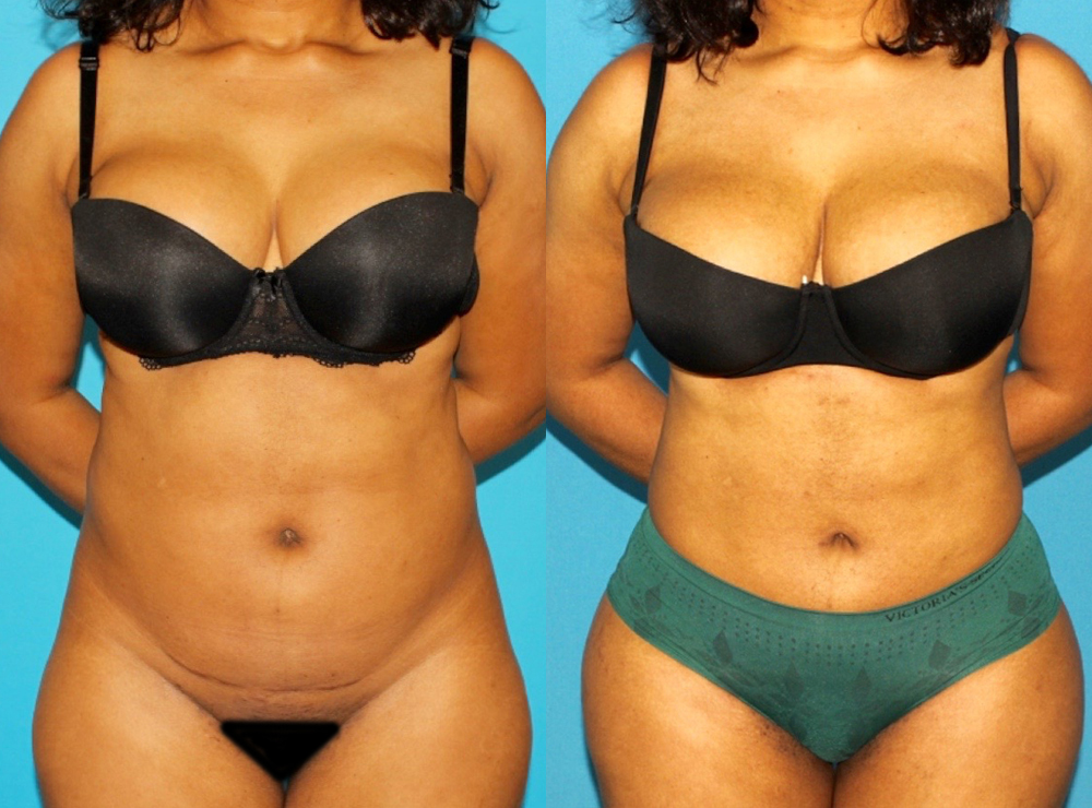 Brazilian Butt Lift case #4906