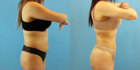 Liposuction case #6008
