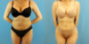 Liposuction case #6008 slider thumbnail