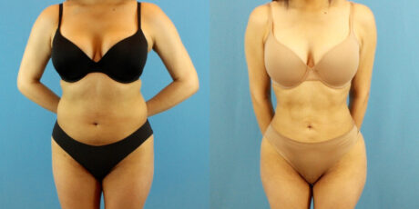 Liposuction case #6008