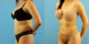 Liposuction case #6008 slider thumbnail