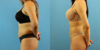 Liposuction case #6008 slider thumbnail