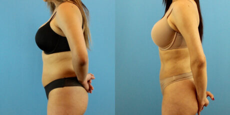 Liposuction case #6008