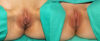 Labiaplasty case #5755 slider thumbnail