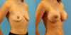 Breast Augmentation case #6333 slider thumbnail
