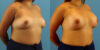 Breast Augmentation case #6340 slider thumbnail