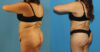Tummy Tuck case #7347 slider thumbnail