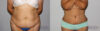 Tummy Tuck case #7085 slider thumbnail