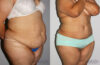 Tummy Tuck case #7085 slider thumbnail