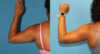 Tummy Tuck case #7348 slider thumbnail