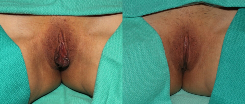 Labiaplasty case #5758