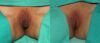 Labiaplasty case #5758 slider thumbnail