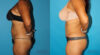 Tummy Tuck case #7230 slider thumbnail
