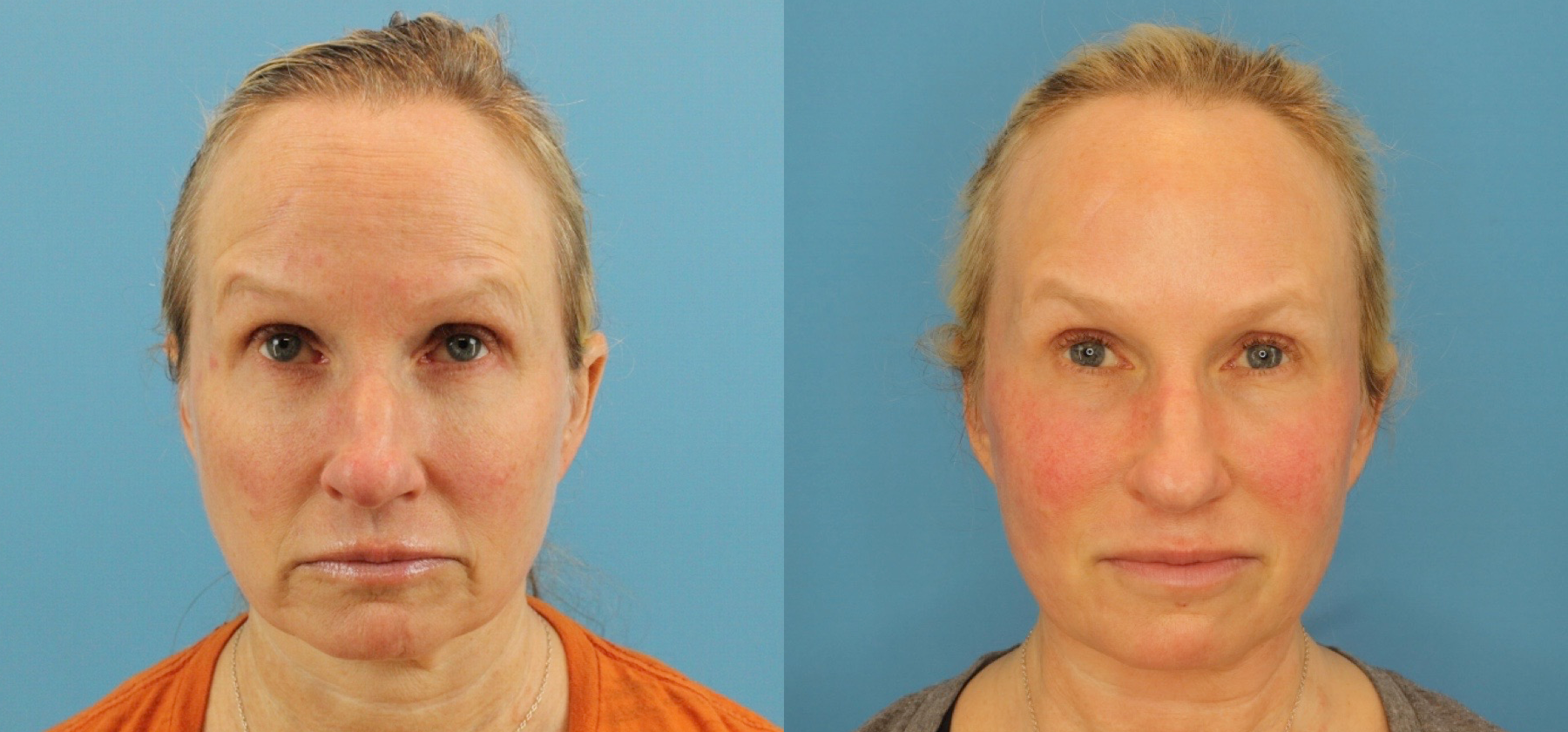 8181-8808-51169-Profound-RF-Skin-Tightening-before-and-after-photo-by-Dr.-Erika-A.-Sato-in-Houston-TX