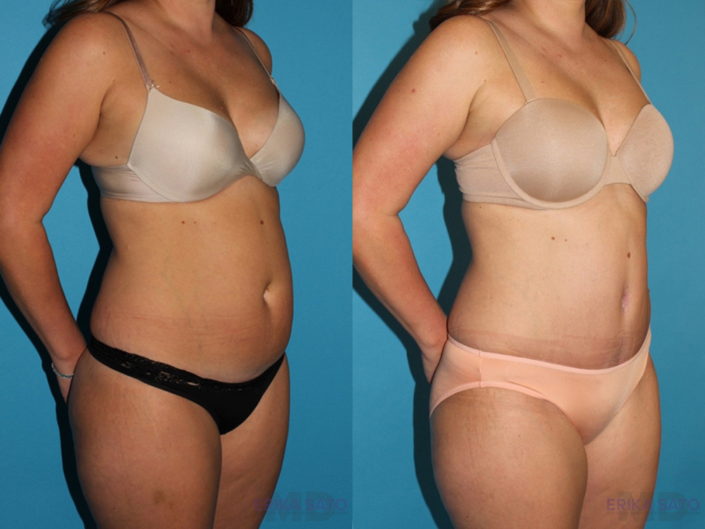 Tummy Tuck case #7229