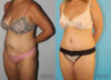 Tummy Tuck case #7228 slider thumbnail