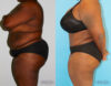 Tummy Tuck case #7084 slider thumbnail
