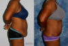 Tummy Tuck case #7082 slider thumbnail