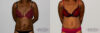 Tummy Tuck case #7081 slider thumbnail