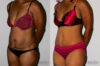 Tummy Tuck case #7081 slider thumbnail