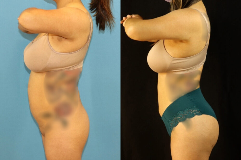 Brazilian Butt Lift case #5117