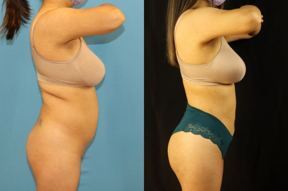 Brazilian Butt Lift case #5117