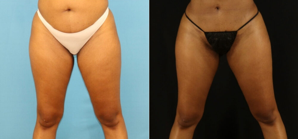 Brazilian Butt Lift case #5115