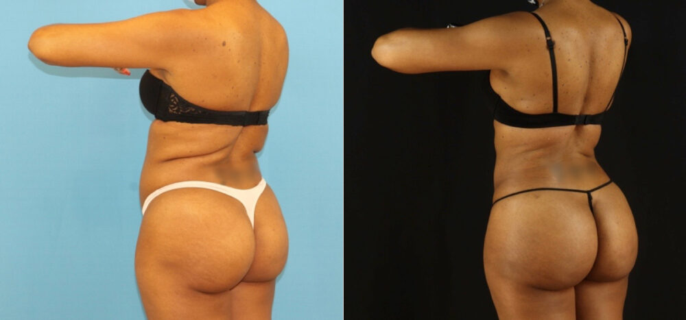 Brazilian Butt Lift case #5115