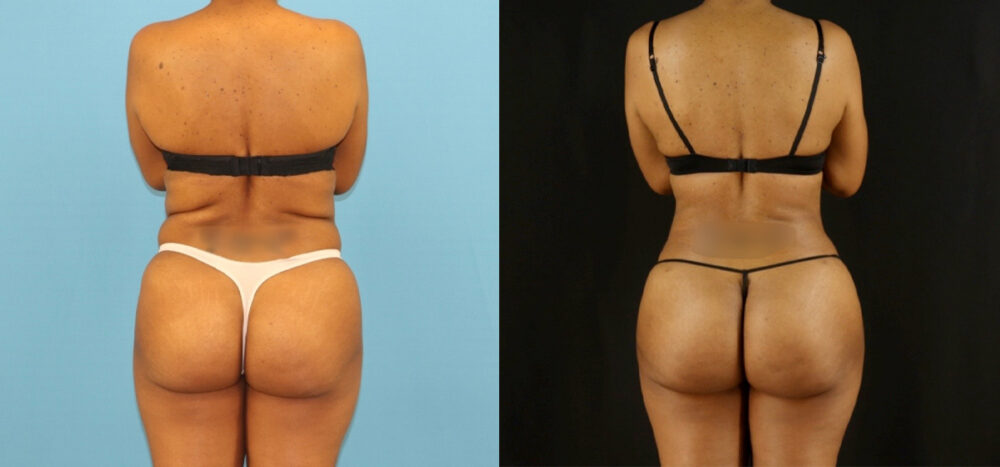 Brazilian Butt Lift case #5115