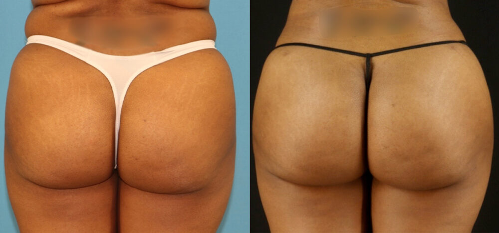 Brazilian Butt Lift case #5115